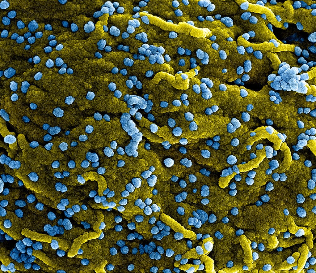 Coronavirus : l’essai clinique Discovery cherche-t-il à favoriser le Remdesivir de Gilead ?