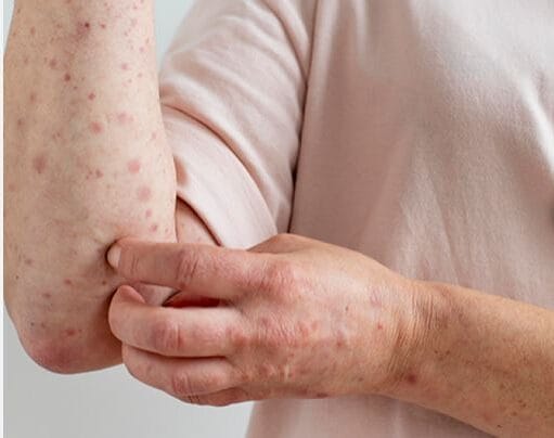 Royaume-Uni : point sur les cas de lèpre liés au vaccin Pfizer